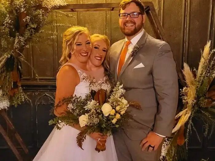 Popular American conjoined twin gets married